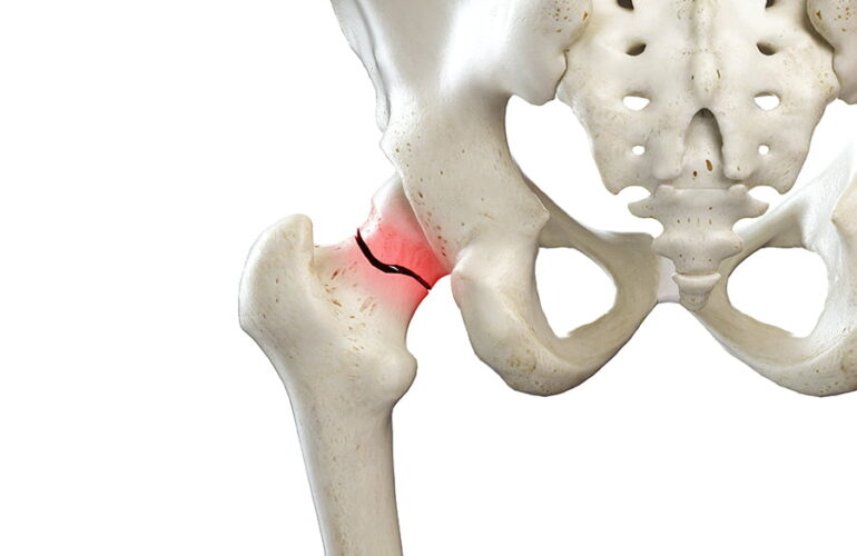 Joint Fracture